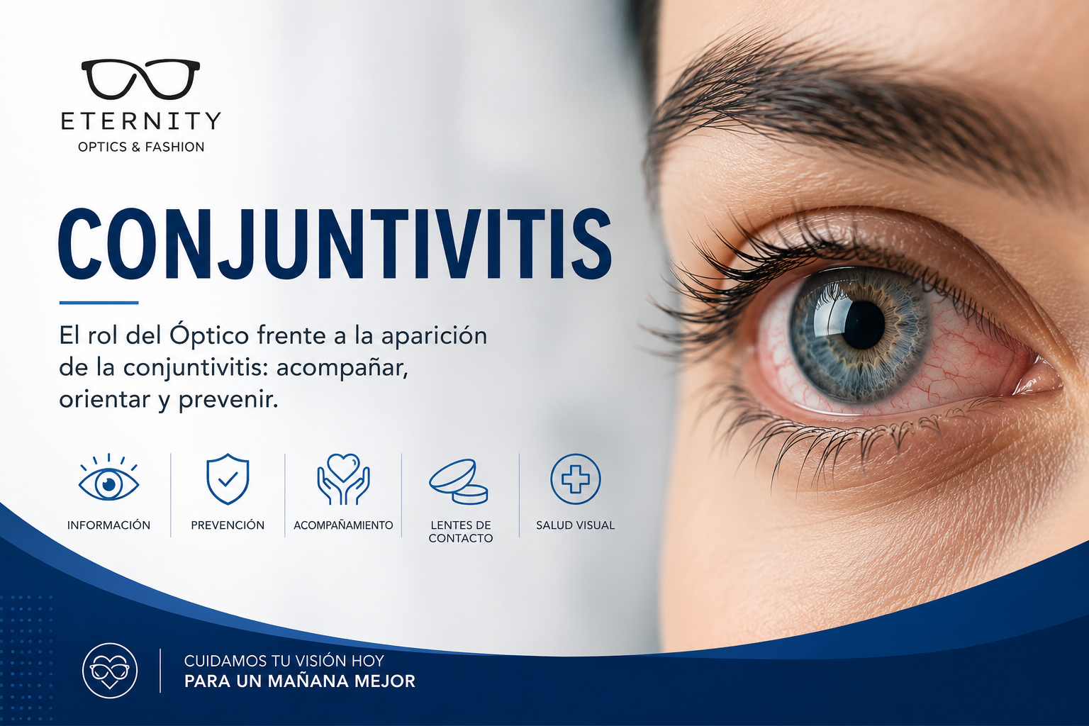 Primer plano de un ojo con enrojecimiento por conjuntivitis — Eternity Óptica